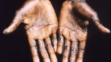 Photo of Ghana records first cases of Monkeypox