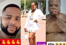 Photo of Sad! Lady pours acid on her boyfriend for allegedly cheating on her