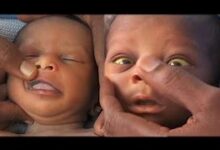 Photo of Jaundice in newborn babies on the rise in Volta Region