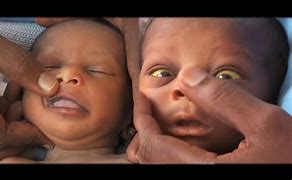 Photo of Jaundice in newborn babies on the rise in Volta Region